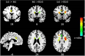 E' vero amore? Lo scoprirà risonanza magnetica cervello. In chi e' innamorato si attivano alcune aree specifiche