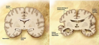 Alzheimer, nuovo farmaco potrebbe ritardarne la progressione. Primi risultati presentati a Conferenza internazionale in Usa