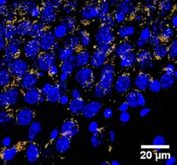 Nanoparticelle contro le placche dell'Alzheimer. Ideate e brevettate da ricercatori italiani